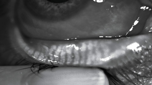 AI can be utilized to estimate the amount of gland atrophy of the meibomian glands (pictured here).
