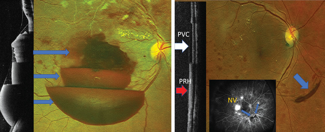 Identifying diabetic retinopathy biomarkers with OCT | Optometric ...